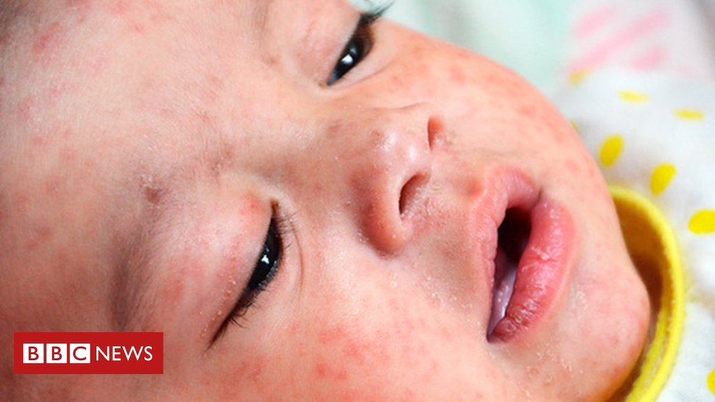 Soaring rates of measles in Europe