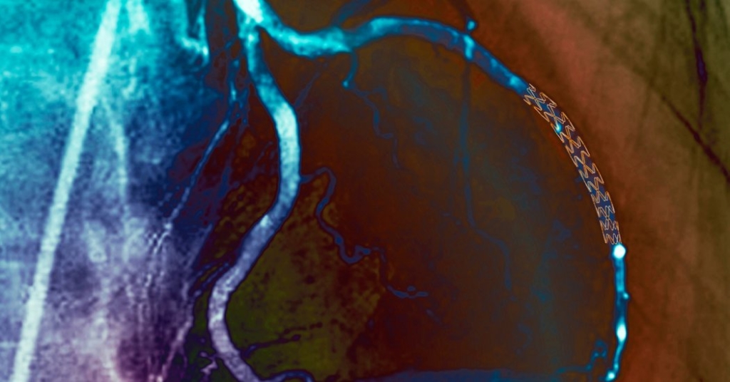 Surgery for Blocked Arteries Is Often Unwarranted, Researchers Find